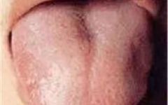 A Comprehensive Guide to 22 High-Definition Tongue Diagnosis Images: Understand Diseases Through Tongue Observation!