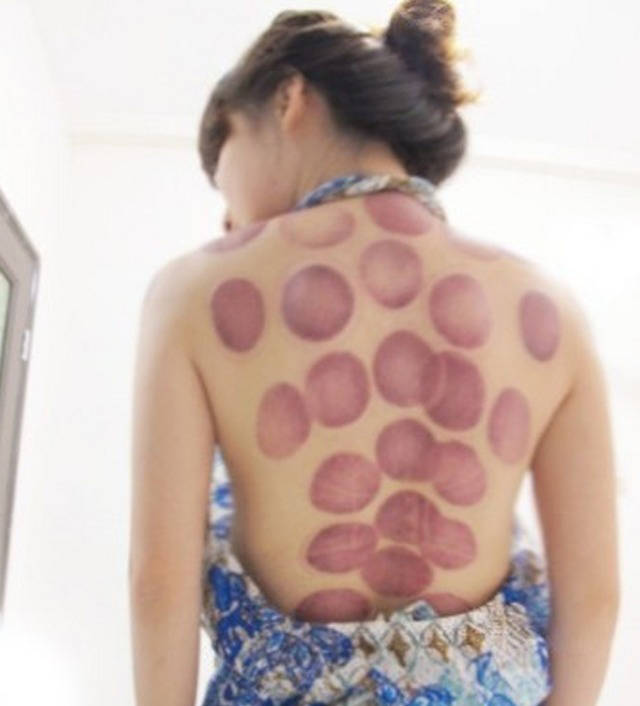 What Do Cupping Marks Indicate After Treatment?