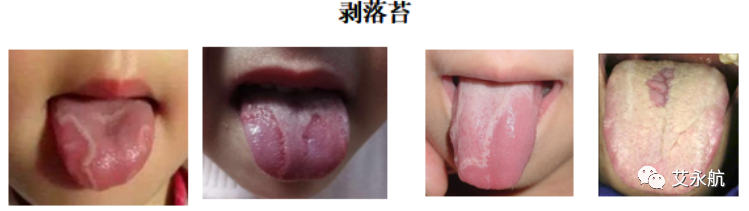 Understanding Disease Through Tongue Diagnosis in Traditional Chinese Medicine