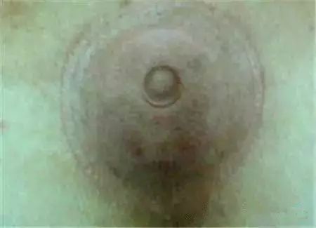 Cupping Therapy on the Back: More Effective than Medication!