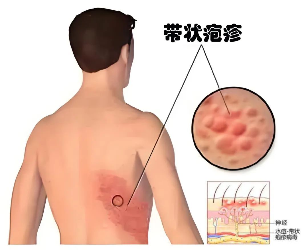Exploring 'Fire Needle' as a Traditional Chinese Medicine Treatment for Herpes Zoster