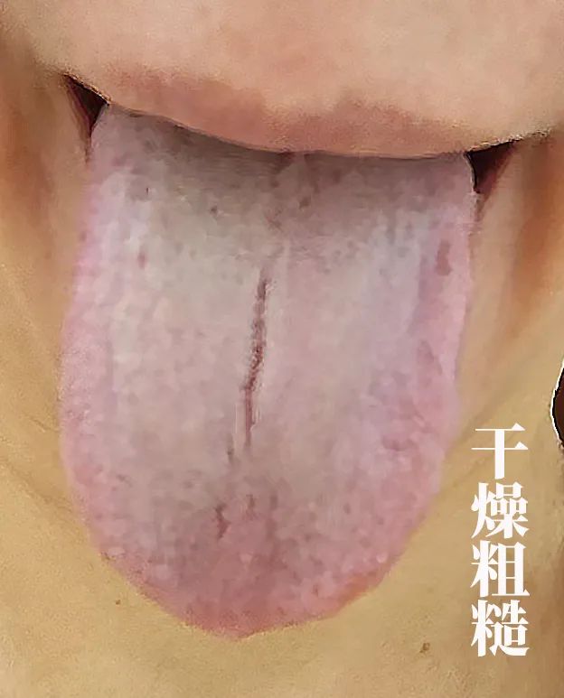 The Body Signals Illness: Understanding Tongue Diagnosis in TCM