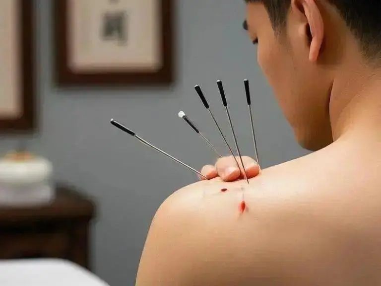 Cupping Therapy for Sciatica: Find the Right Acupoints for Easy Relief!