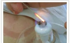 Characteristics of Fire Needle Therapy in Traditional Chinese Medicine