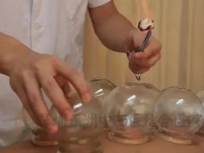 Ten Common Cupping Therapy Techniques