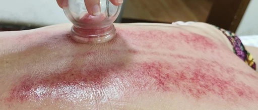 Cupping Therapy: A Traditional Method for Moisture Removal