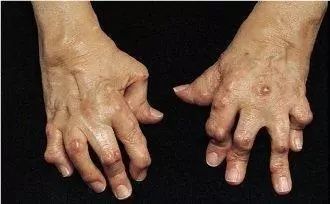 Fire Needle Therapy for Rheumatoid Arthritis