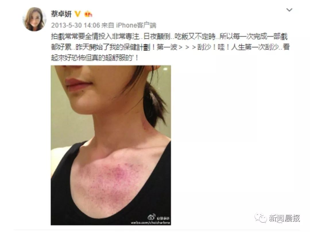 Caution: A Male Celebrity's Bare Back Photo Startles Netizens - Important Tips for Gua Sha This Summer