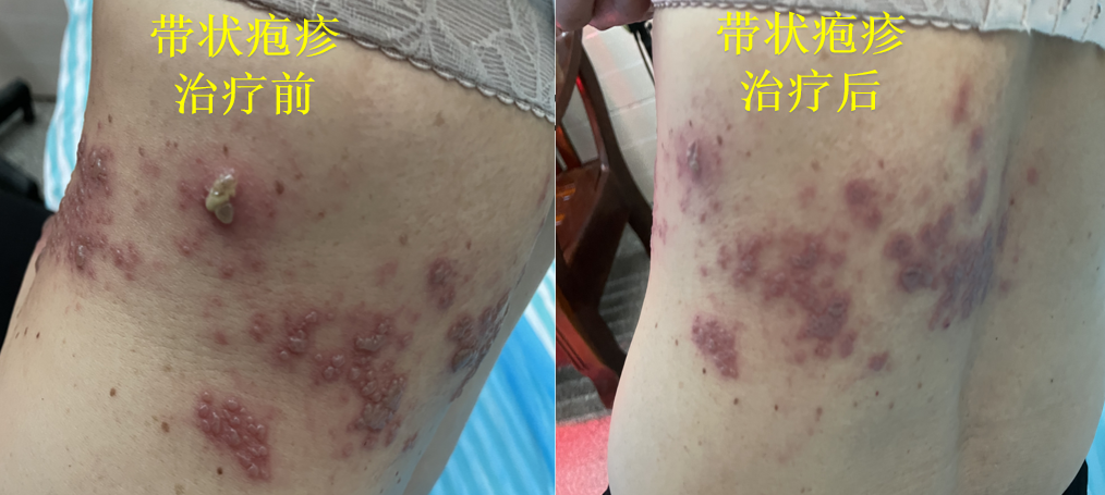 Essential Knowledge of Fire Needle Therapy in Dermatology