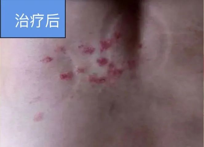 Dermatology: TCM Fire Needle Technique for Treating Skin Diseases
