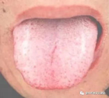 Tongue Diagnosis in Traditional Chinese Medicine: Tongue Coating