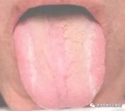 Tongue Diagnosis in Traditional Chinese Medicine: Characteristics of Tongue Coating