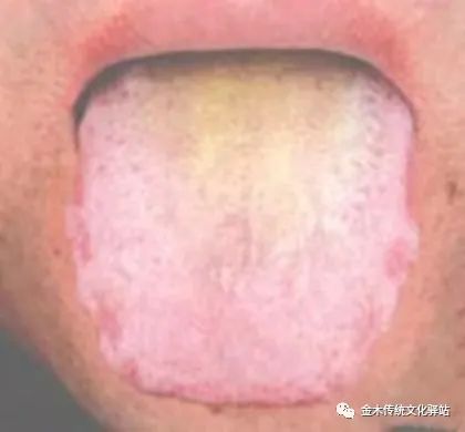 Tongue Diagnosis in Traditional Chinese Medicine: Characteristics of Tongue Coating