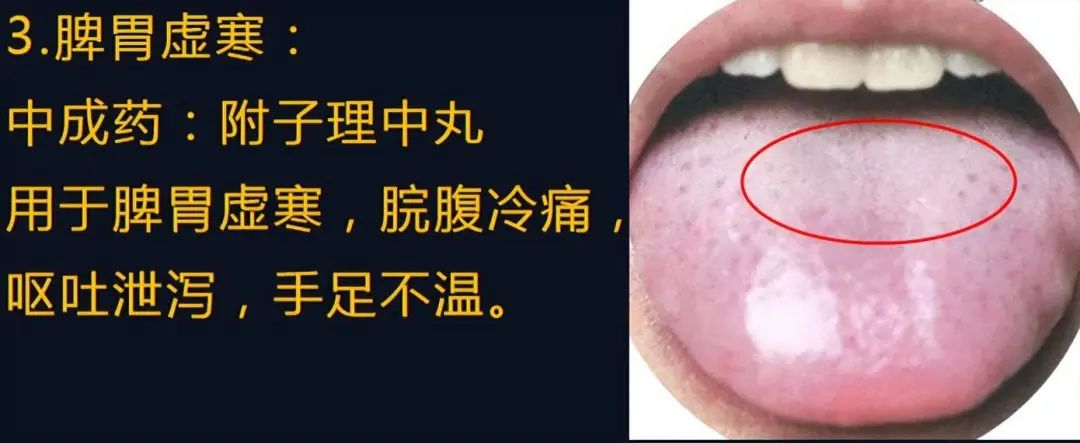 Four Types of Spleen Qi Deficiency: Which One Are You?