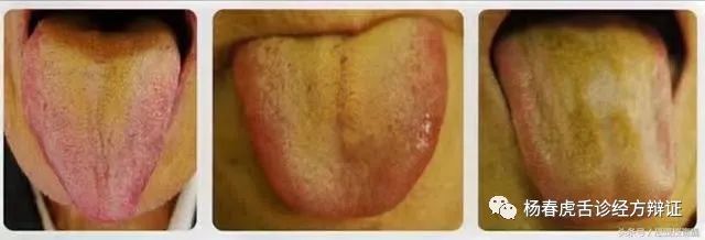 Foundations of Traditional Chinese Medicine: Phlegm-Dampness