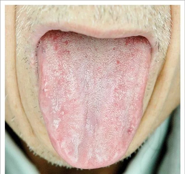 Traditional Chinese Medicine Tongue Diagnosis: 26 Clinical High-Definition Tongue Diagnosis Images with Analysis