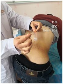 Understanding Fire Needle Therapy in Traditional Chinese Medicine
