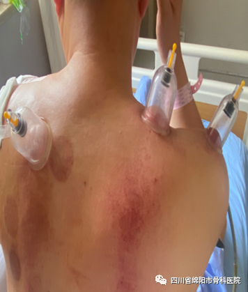 The Profound Knowledge of Cupping Therapy in Traditional Chinese Medicine