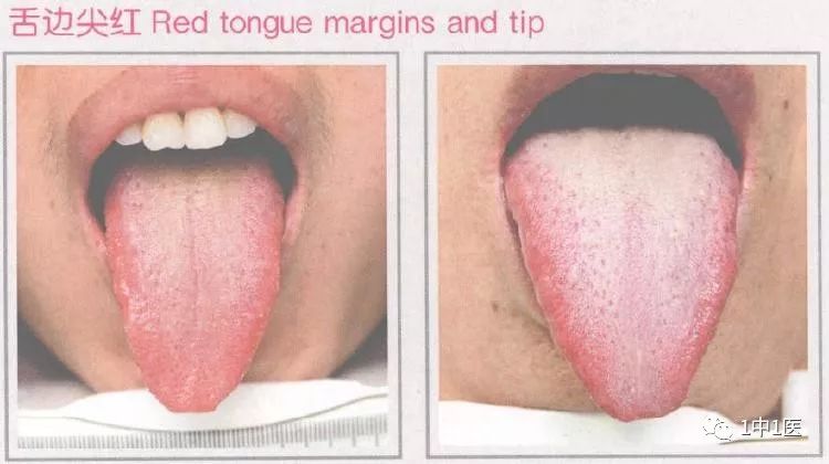 Learning Tongue Diagnosis from Scratch 5 - Tongue Color 3