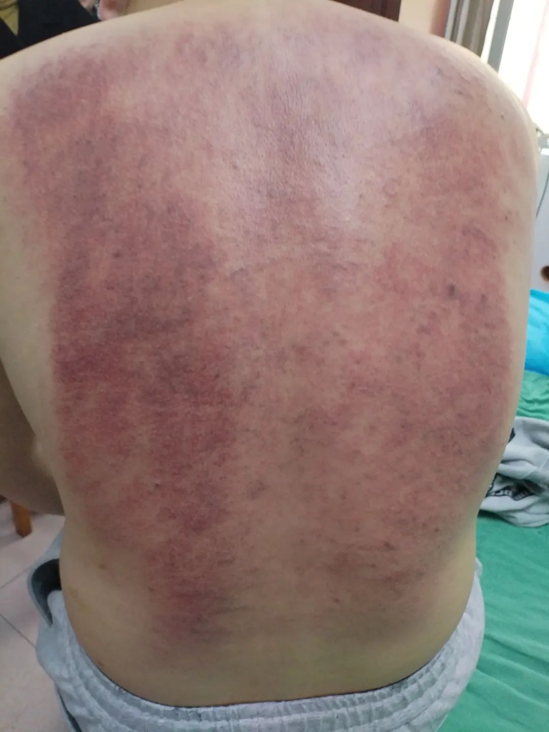 Cupping Therapy for Insomnia