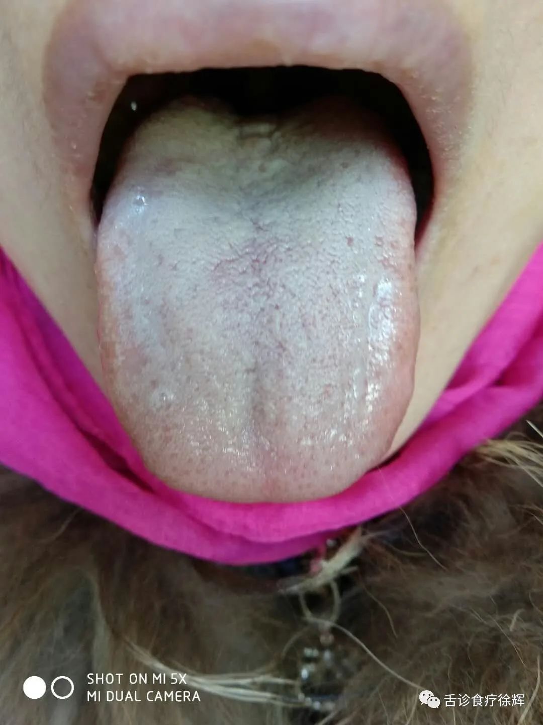Distinguishing Between Yang Deficiency and Blood Deficiency with Pale Tongue