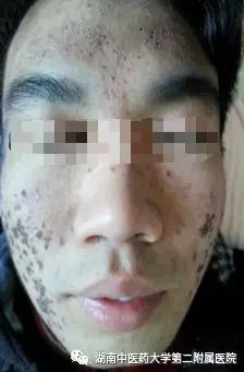 Unique Techniques of Fire Needle Therapy for Skin Diseases