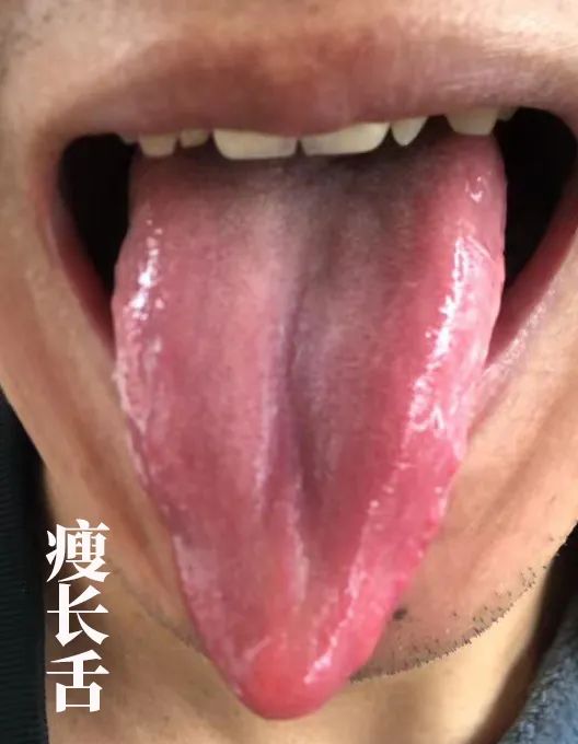 The Body Signals Illness: Understanding Tongue Diagnosis in TCM