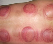 Understanding Cupping Therapy: Common Misconceptions and Precautions