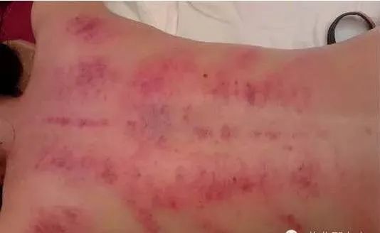 The Most Comprehensive Guide to Gua Sha Knowledge