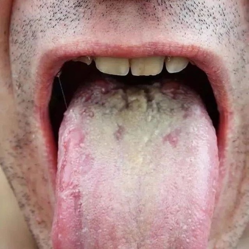 Tongue Diagnosis in Traditional Chinese Medicine: Observing Tongue Color, Shape, State, and Coating