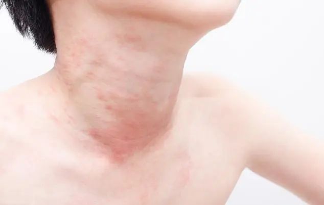 Moxibustion to Prevent the Three Evils: Achieve Clarity and Vitality with These Practices