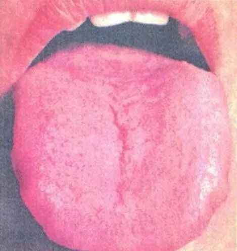 Comprehensive Guide to Tongue Diagnosis and Associated Conditions in TCM