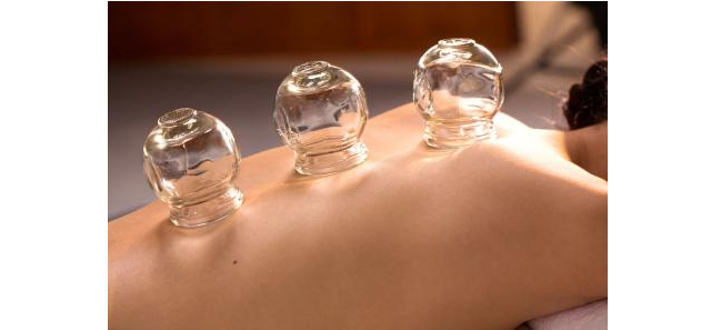 Cupping Therapy: A Traditional Chinese Medicine Approach to Health