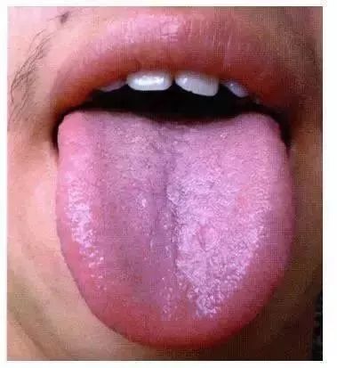What Can Traditional Chinese Medicine Reveal Through Tongue Diagnosis?
