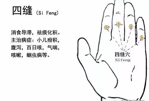 Utilizing the Four Seam Points for Bloodletting: Enhancing Appetite and Clearing Heat to Unblock Meridians
