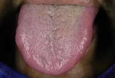 Tongue Diagnosis - Illustrated Guide to Tongue Manifestations