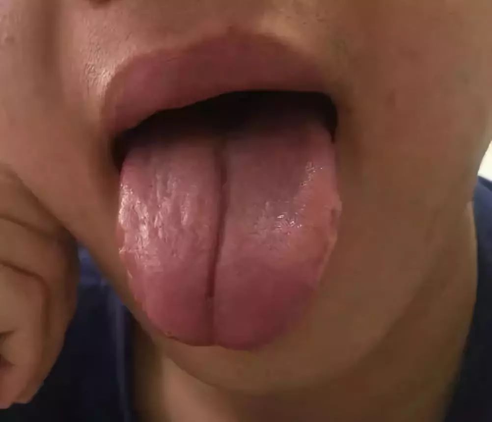 A Series on Tongue Diagnosis