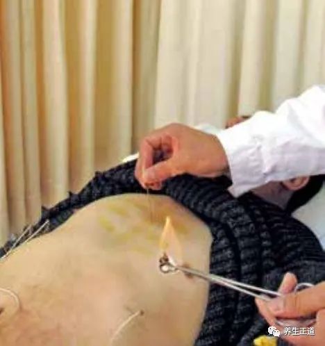 Traditional Chinese Medicine Acupuncture: The Art of Fire Needle Therapy