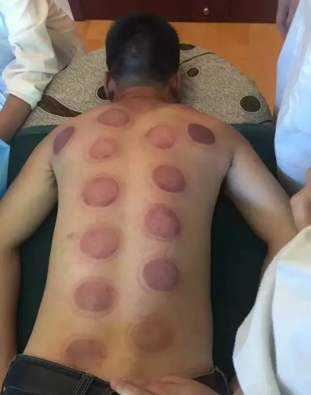 Cupping Therapy in Traditional Chinese Medicine: Meaning, Functions, Contraindications, and Precautions