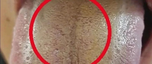 Halitosis and Bitter Taste Often Indicate Spleen-Stomach Damp-Heat: Regaining Health