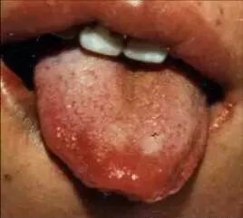 Tongue Diagnosis - Illustrated Guide to Tongue Manifestations