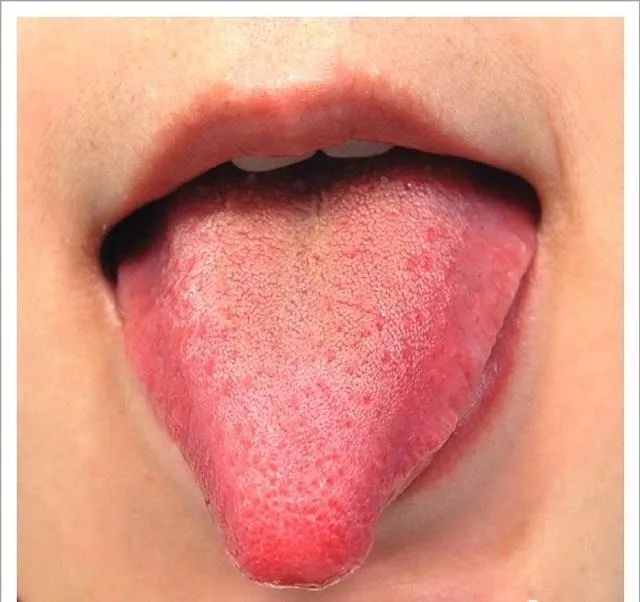 Traditional Chinese Medicine Tongue Diagnosis: 26 Clinical High-Definition Tongue Diagnosis Images with Analysis