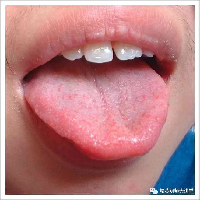 Traditional Chinese Medicine Tongue Diagnosis: Illustrated Guide to 14 Types of Tongue Shapes and Qualities