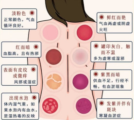 Understanding Cupping Therapy: Common Misconceptions and Precautions