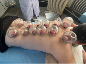 Unique TCM Therapy: Bloodletting for Pain Relief