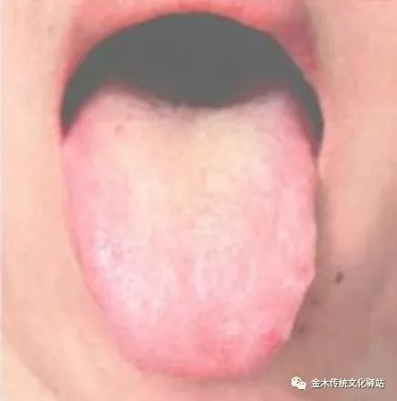 Tongue Diagnosis in Traditional Chinese Medicine: Tongue Coating