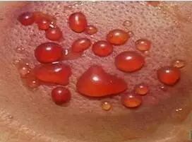 A Comprehensive Guide to Cupping Therapy