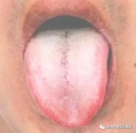 Tongue Diagnosis in Traditional Chinese Medicine: Tongue Coating