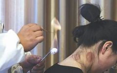 Acupuncture Department II: What Conditions Can Fire Needle Therapy Treat?