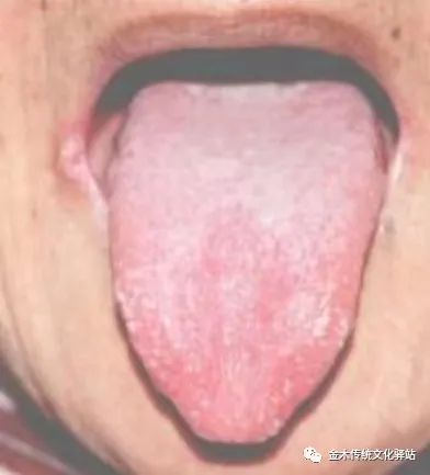 Tongue Diagnosis in Traditional Chinese Medicine: Characteristics of Tongue Coating